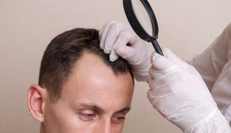 Saçtaki Değişiklikler Alzheimer Habercisi Olabilir!