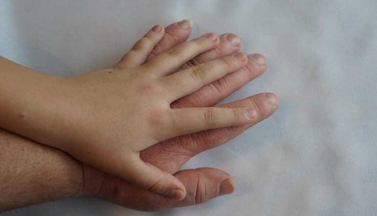 Büyüme Hastalığı(Akromegali) Nedir?